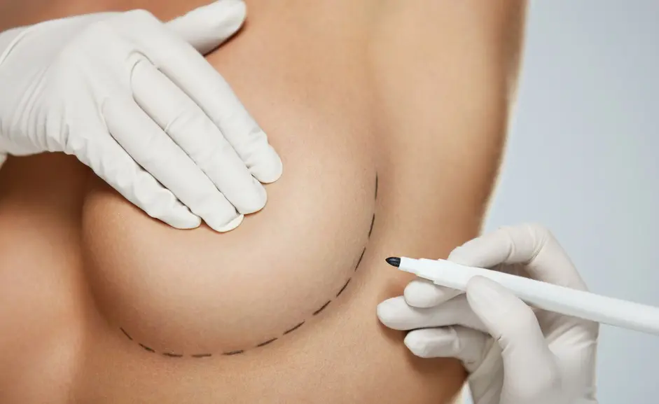 Mamoplastia